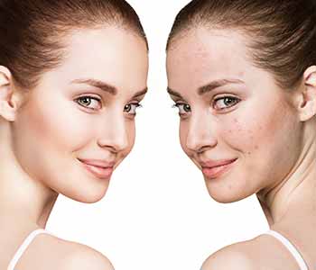 At Image Dermatology, acne treatment is never one-size-fits-all.