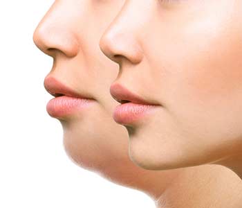 Provides Kybella Double Chin Treatment in Montclair NJ area