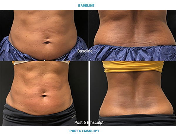 What is EMSculpt? Non-Surgical Body-Sculpting and Muscle Toning