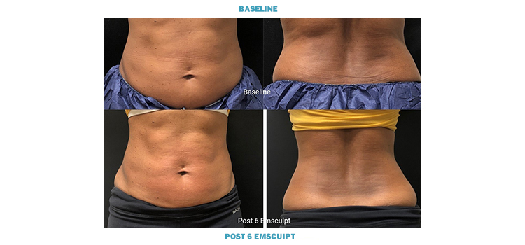 Contour Your Body Non-Surgically with EmSculpt Neo Fat Reduction