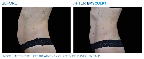 Differences between CoolSculpting and Emsculpt – What is Best for Me? -  Sculpt MD