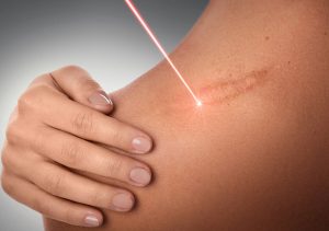 What Are the Benefits of the Fraxel Laser Procedure In Montclair NJ Area