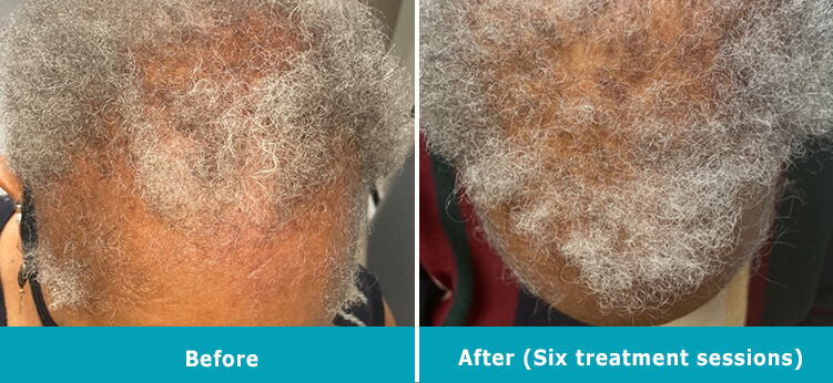 Hair Restoration Montclair NJ - Laser Hair Rejuvenation 