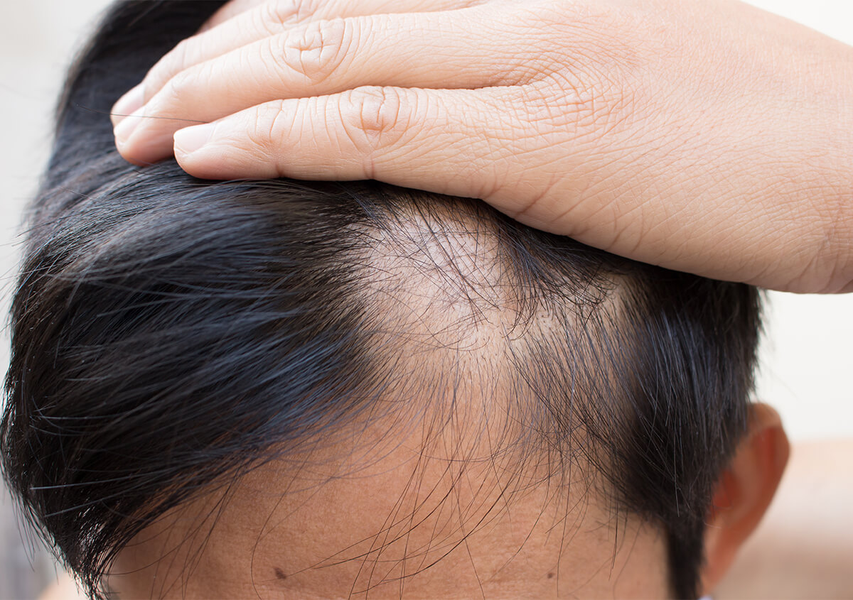 Hair Restoration Montclair NJ - Laser Hair Rejuvenation 
