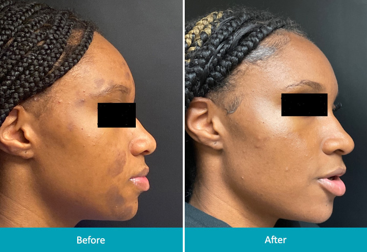 Chemical peels from a dermatologist