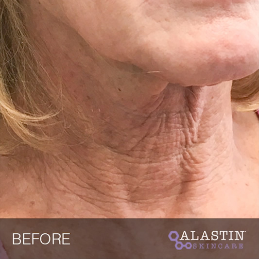Alastin Skin Care - Before 11
